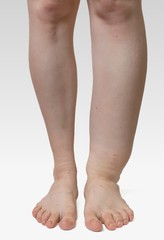 Lymphdrainage